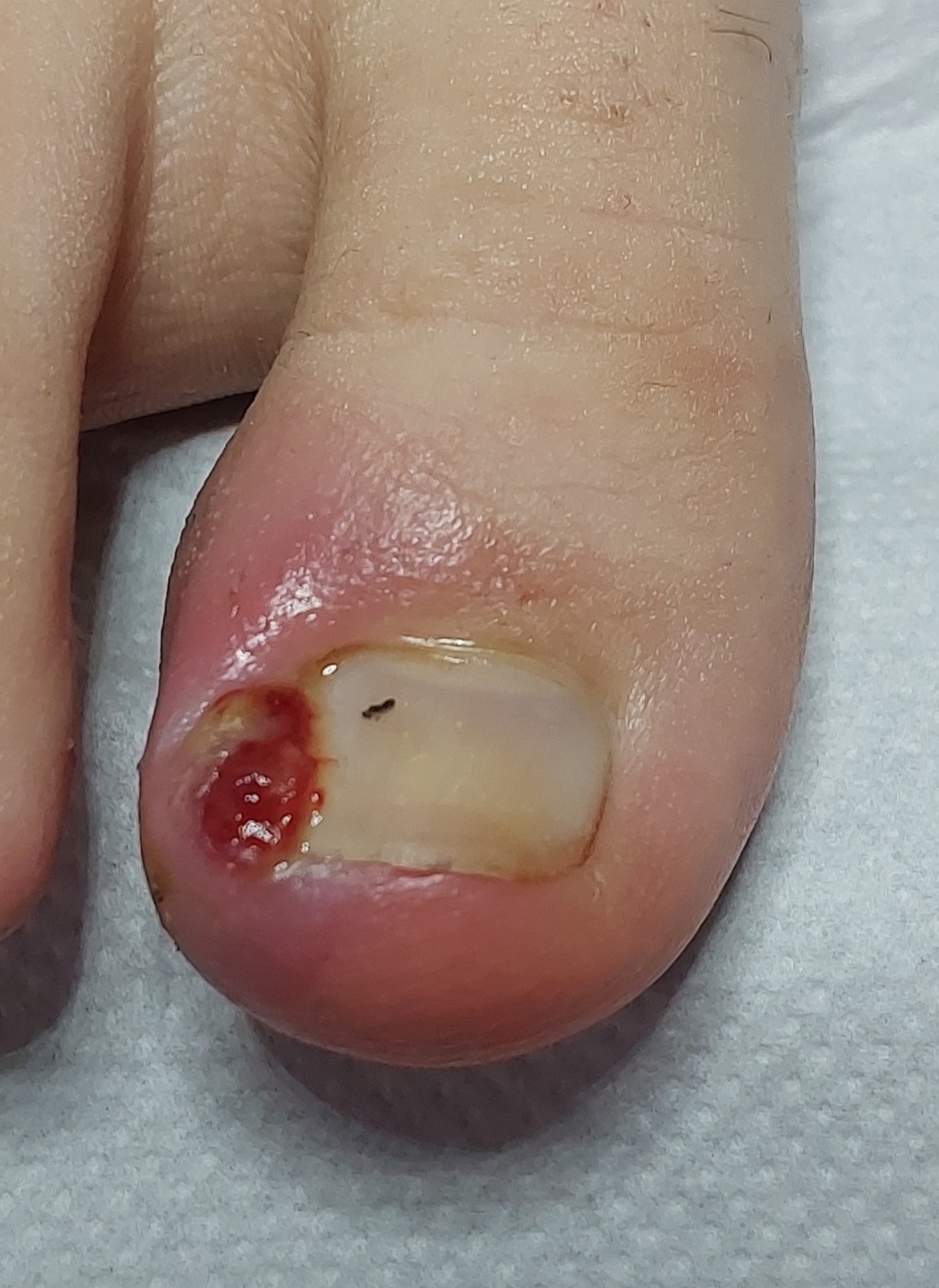 wrastajacy_paznokiec