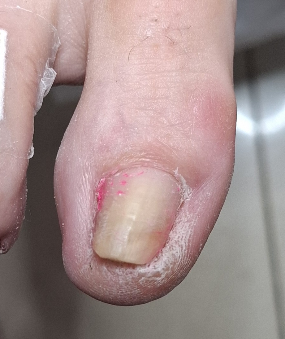 wkrecajacy_paznokiec